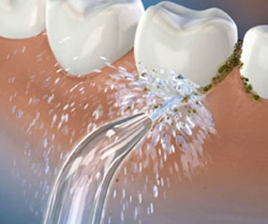 Illustration of a Waterpik™ water flosser tip shooting water at the gumline of a tooth and dislodging plaque and debris