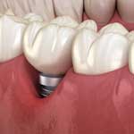 Tooth and gums with implant tooth showing