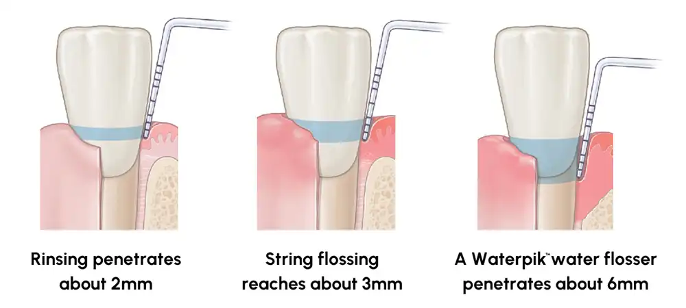 Rinse vs. String vs. Waterpik Water Flosser comparison graphic